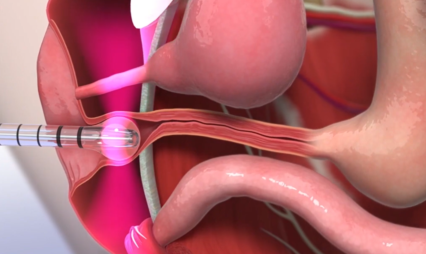 Gynecological Laser Treatment Illustration