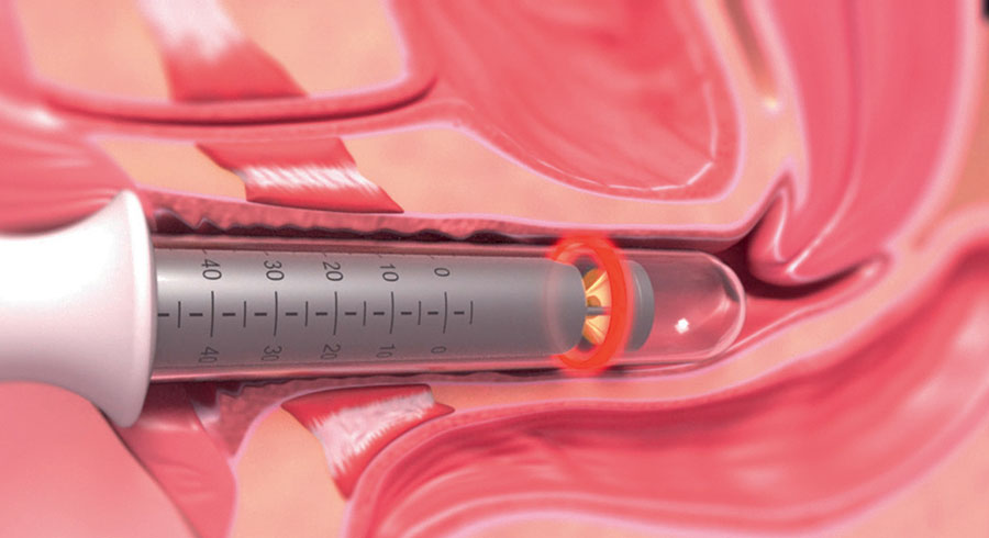 Gynecological Laser Treatment Illustration