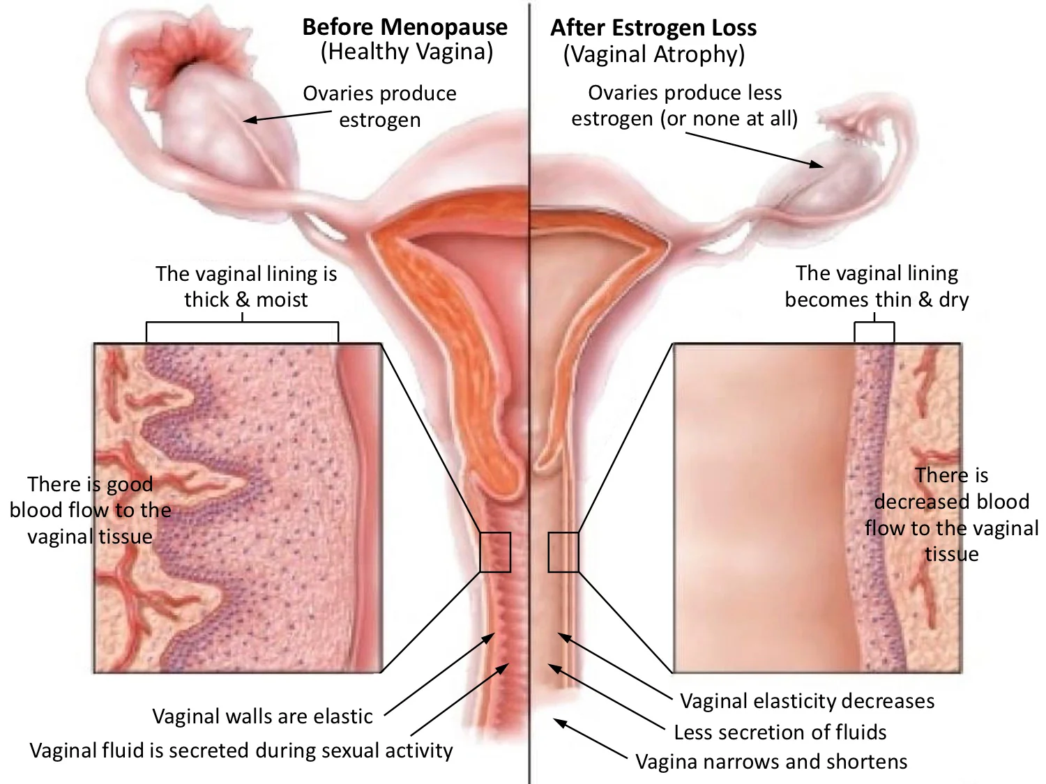 Gynecological Laser Treatment Illustration